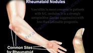 Rheumatoid Arthritis of the hand - Everything You Need To Know - Dr. Nabil Ebraheim
