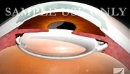 Eye Surgery- Cataract with Lens Replacement