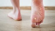 What's the Best Treatment for Warts on the Foot and Toes? | Family Foot Care & Surgery