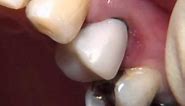 Tooth Crowns Porcelain Fused to Metal - Roseville Dentist