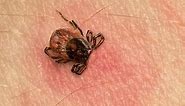 Here’s What a Tick Bite Actually Looks Like