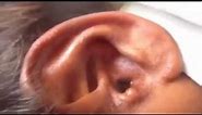 Ear botfly Botfly extraction human YouTube