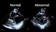 Echocardiogram from the Patient Compared with That from a Normal Control | NEJM