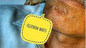 Warts on face , filiform warts removed