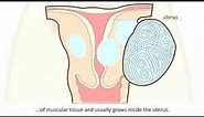 Fibroid - What is a fibroid and how can it be treated?