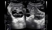 Ultrasound Video showing Two types of Ovarian Cysts and an Ovarian Mass.