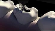 3d Animation of Caries Removal & The Cavity Filling Procedure - NYC Dentist - Dr. Simon Rosenberg