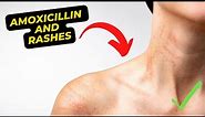 Amoxicillin and Rashes Understanding the Connection and How to Manage It