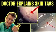 Doctor explains SKIN TAGS - including CLINICAL PHOTOS, CAUSES & TREATMENT