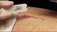 SutureOut The Easy Way to Remove Sutures