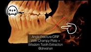 Mandibular Angle Fracture ORIF Champy Technique and Wisdom Tooth Extraction