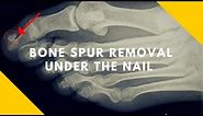 Bone Spur Under Big Toe Nail (Subungual Exostosis)