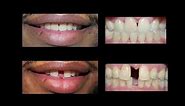 Invisaign for Teeth Gap Treatment at Cosmetic Dental Associates