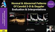Normal & Abnormal Patterns of Carotid Doppler