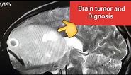 Meningioma -extra-axial brain tumor