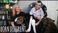 The Incredible Teen With Butterfly Skin | BORN DIFFERENT