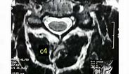 Spine Lecture: How to Read a Cervical MRI