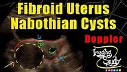 Fibroid Uterus with Nabothian Cysts || Ultrasound || Doppler || Case 267