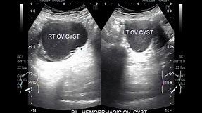 Bilateral Ovarian Cysts, Two cases.