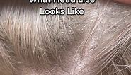 What Head Lice Looks Like 😳 #explore #piojos #headlice #liceinfestation #licetok #liceremoval #hair