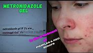 Metronidazole gel for Pimples and Red bumps||Treating Rosacea and Inflammatory Lesions