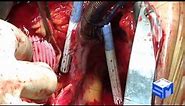 Ascending Aortic Replacement Operation • Video • MEDtube.net