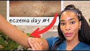 12 Life Changing Tips For Eczema: From a Derm with Eczema