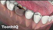 Dental Abscesses (480p)