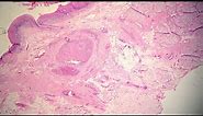 Well Differentiated Squamous Cell Carcinoma, Verrucous Type