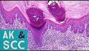 Squamous Cell Carcinoma & Actinic Keratosis 101...Dermpath Basics & Beyond