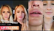 My first time getting LIP FILLERS before AND after - 1 syringe Juvederm Ultra