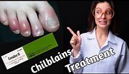 what is Chilblains| chilblains treatment| Doctor farzana
