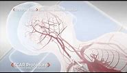 Stroke Prevention - Carotid Artery Disease