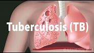 Tuberculosis (TB): Progression of the Disease, Latent and Active Infections.
