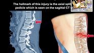 Flexion Distraction Injury Of The lumbar Spine - Everything You Need To Know - Dr. Nabil Ebraheim