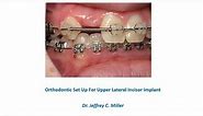 Orthodontic Set Up For Upper Lateral Incisor Implant