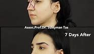 Causes and Consequences of Failed Rhinoplasty | Prof. Dr. Suleyman TAS