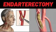 WHAT IS ENDARTERECTOMY? - Carotid Endarterectomy Surgery, Indications,