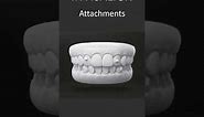Invisalign Attachments | How They Work | London UK