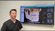 Could I get nerve damage after wisdom teeth removal?