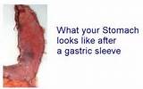 Images of Gastric Sleeve Portion Size