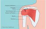 Pictures of Rotator Cuff Tear Symptoms