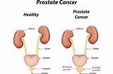 Pictures of Prostate Cancer News