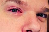 Photos of Eye Viral Infection Symptoms