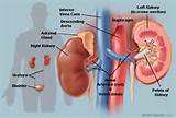 Chronic Kidney Liver Disease