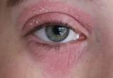 Medical Conditions That Cause Dry Skin Photos