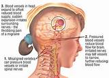 Pictures of Migraine Headache Blurred Vision