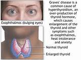 Images of Autoimmune Thyroid Disease Symptoms