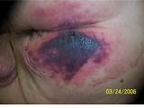 Suspected Deep Tissue Injury Pictures