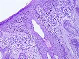 Pictures of Melanoma Pathology Outlines
